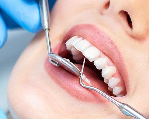 N2O in the treatment of teeth